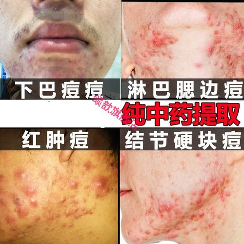 淋巴痘祛痘膏纯中药下巴淋巴腮边红肿硬块痘结节性痘痘痤疮额头反复长