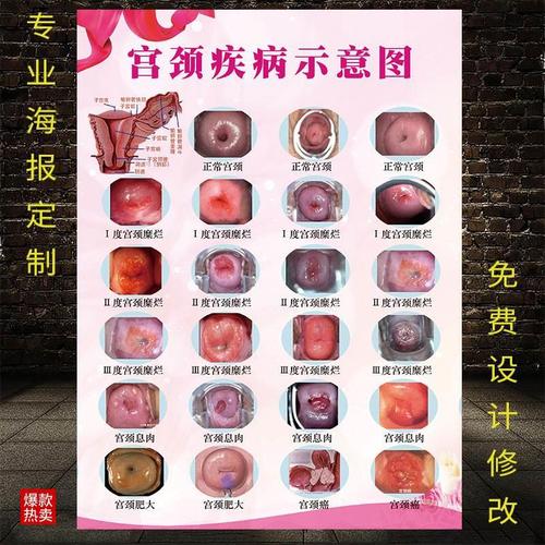 宫颈疾病示意图妇科墙贴病变级别海报炎症子宫图片美容院挂图广告