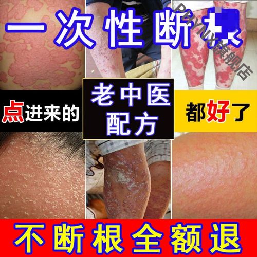 牛皮l癣银l屑湿l疹皮肤l病专用治l疗止痒去l根手足股l藓外用l癣l藓膏