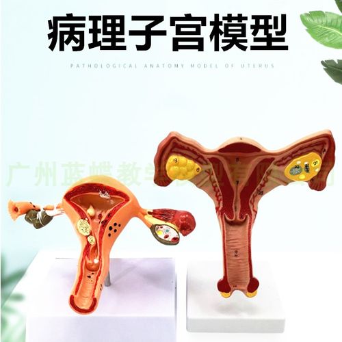 病理病变子宫,卵巢 生殖科  病理子宫模型 妇科女性子宫病理模型