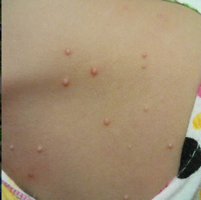 无痛 面部宝宝去传染性软疣水猴子病毒性软疣眼角大人私处瘊子水