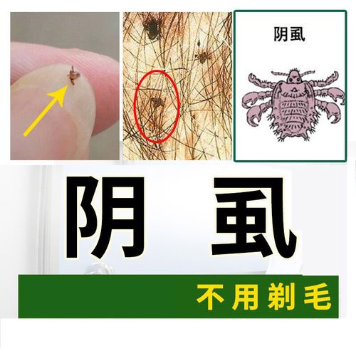 阴虱男女士私处阴虱10%硫磺乳膏私处阴囊瘙痒林ld旦百部酊喷剂虱卵虱