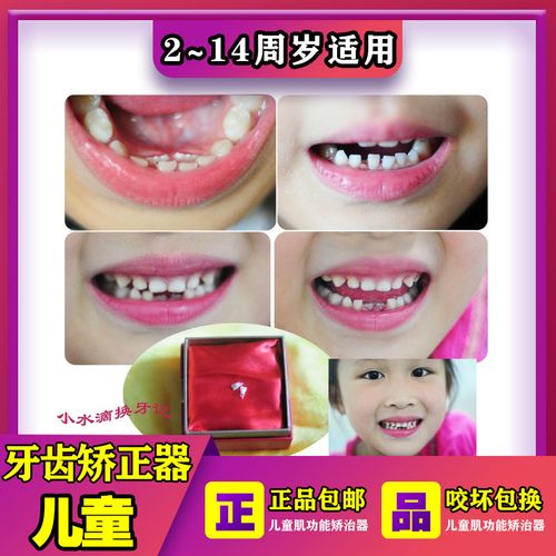 儿童牙套矫正器纠正牙齿不齐错位门牙外凸反颌兜齿凸嘴地包天咬合