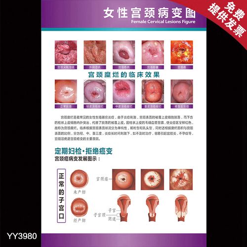 女性正常的子宫口解剖挂图 医院妇科女性保健知识海报 妇检宣传画