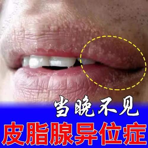 治l疗皮脂腺异位嘴唇异位症增生白点干裂脱皮红肿上火起泡专用箹l膏