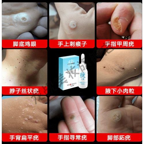 小肉粒颈部赘皮扁平尤温和不留疤祛尤腋下小猴子 一瓶【少量疣体】