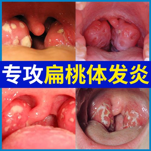 扁桃体发炎喉咙肿痛肥大肿大有痰异物感药嗓子咳嗽贴干痒咽喉喷剂