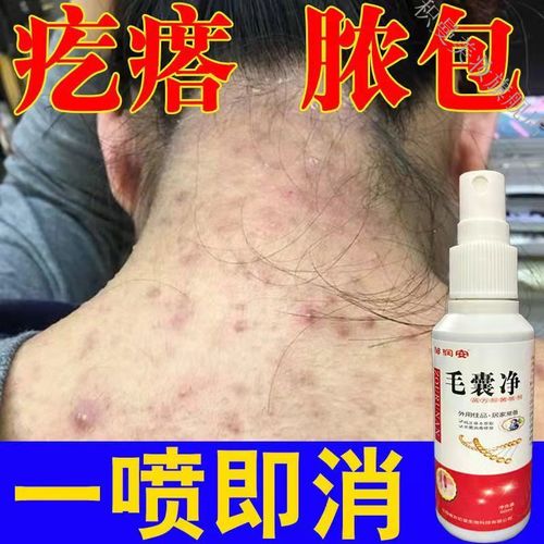 毛囊炎克星喷剂痘痘前胸后背脓包痤l疮头皮头部马拉色菌毛囊炎专用 两