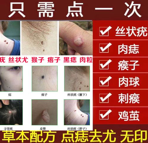 专去脖子上的小肉粒颈部腋下长肉粒猴子肉粒疙瘩除刺猴皮赘去除膏