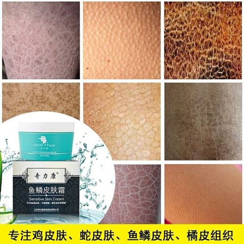 鱼鳞皮肤霜鸡皮肤皮堂蛇皮肤霜去除鱼鳞皮肤全身角质舒滑膏干燥脱皮