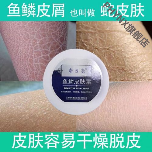 奇力康鱼鳞皮肤霜去鸡皮肤大腿起皮干燥掉屑蛇皮肤腿部病全身保湿