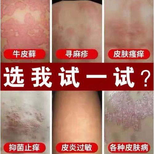 毛囊炎喷雾头皮痒癣抗真菌脂溢性头皮屑癣牛皮痒藓荨麻l疹风团红l斑