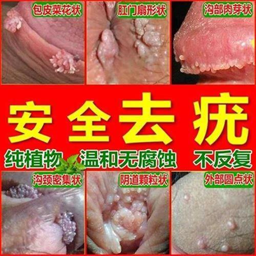 i尖锐疣湿锐疣j体去除尖锐r湿尤私处男女i尖庞疣克净尤易康克优林