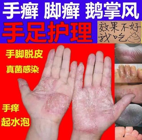 治手癣膏手气膏脚手足癣藓手痒水泡脱皮干裂鹅掌风真菌感染的药膏