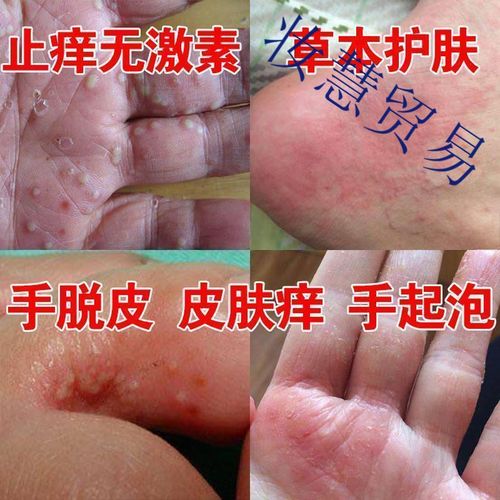 硫磺软膏手上起小水泡手上长水泡手脚脱皮干裂皮肤过敏手瘙痒季节性