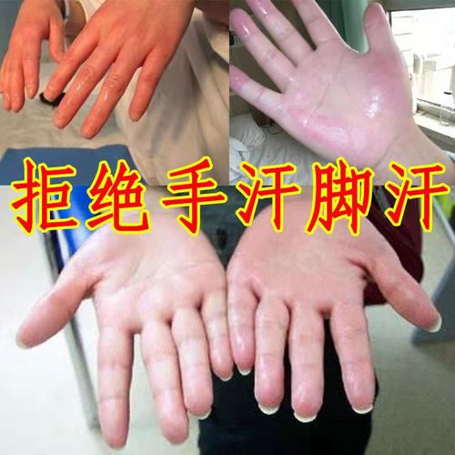 手汗症止汗手心出汗除汗去汗脚腋臭止汗露男女腋下干爽除手脚出汗去