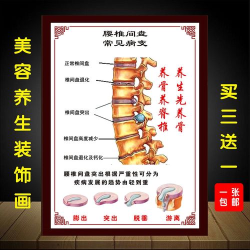 人体颈椎脊椎医学骨骼挂图椎间盘常见病变腰椎间盘突