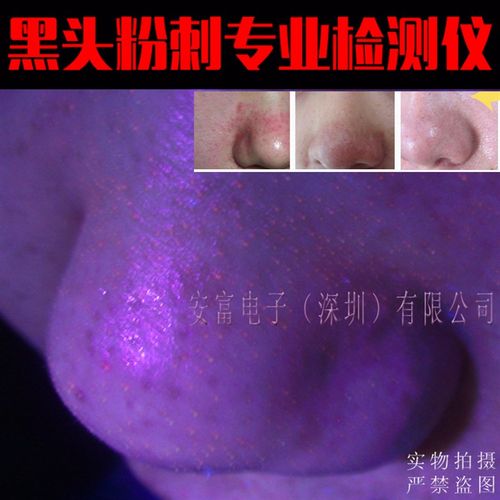 高档伍粉氏灯g白班癣检测皮肤癣美容德诊刺断仪纯uv过