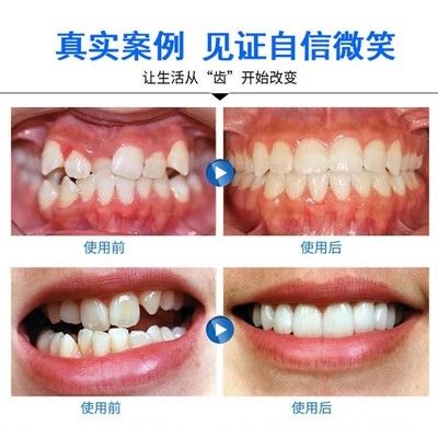 器j爆防牙齿牙套隐形纠正地龅牙款磨牙天.保持缝矫正