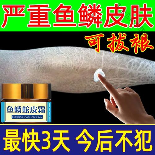 去鱼鳞皮肤霜皮肤干燥起皮治鸡皮肤身体乳腿上粗糙腿部蛇皮肤保湿 五