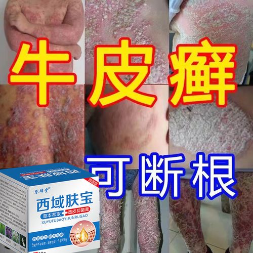 西域肤宝手足l癣花l斑l癣皮l炎荨l麻l疹顽固牛l皮l癣银l屑皮肤瘙痒膏