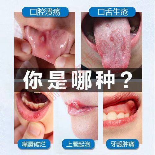 【口腔念珠菌中度】三盒装