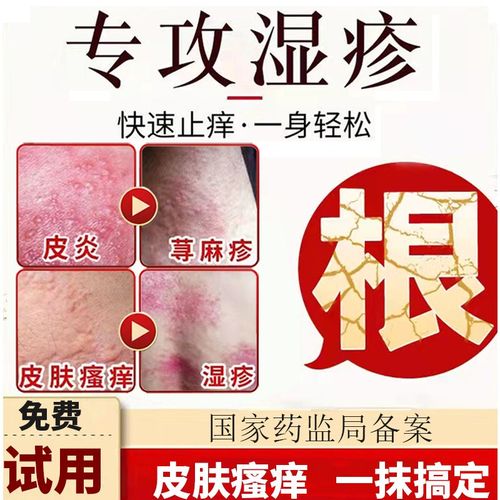 湿疹膏成人皮肤瘙痒顽固慢性皮炎湿疹大腿内侧止痒膏肛门肛周阴囊皮肤