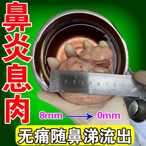 鼻息肉脱落【当晚就掉了】鼻炎喷雾鼻息肉鼻塞鼻甲肥大疏通鼻息肉
