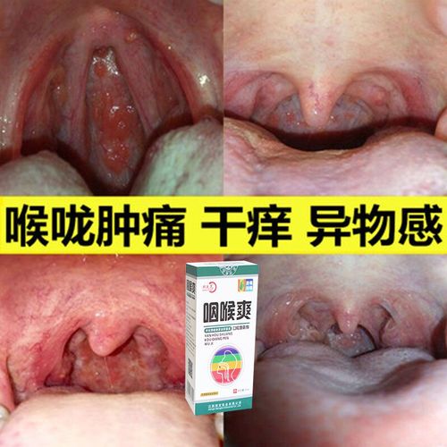 咽喉爽喷剂咳嗽喉咙有痰异物感干痒喉咙发炎肿痛化痰
