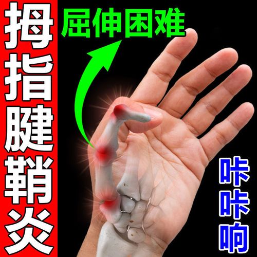 大拇指腱鞘炎凝露手指腕腱鞘囊肿关节肿胀疼痛变形鼓包活动受限