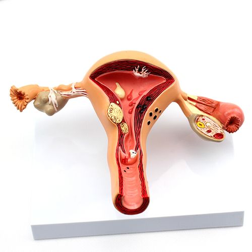 颐诺人体女性子宫卵巢疾病模型生殖科妇产科医患沟通讲解演示模型子宫