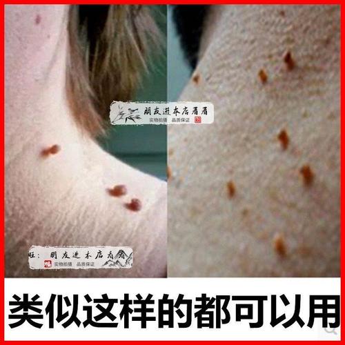 脖子腋下长软小肉疙n瘩球颗粒软垂丝状尤皮赘猴子丝状