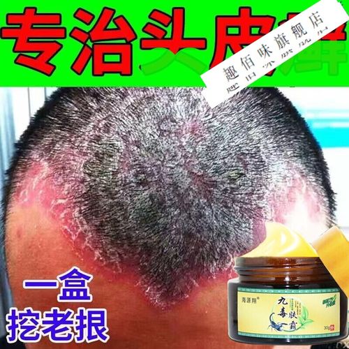 【旗舰出品】头皮ll癣专用膏箹真菌感染治撩头部牛皮l癣银l屑病外用去