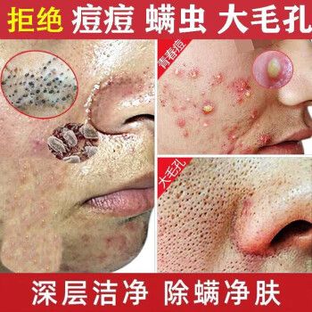 脸上瘙痒出油长痘螨虫在作怪