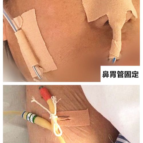 医用胶布鼻胃管胶带鼻管贴导管弹力宜拉胶带鼻饲管鼻胃管固定鼻贴