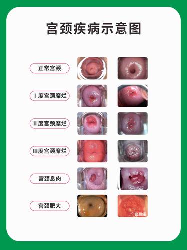 m768医院妇科人体部位宫颈疾病示意图剖析挂图2522海报印制59-15