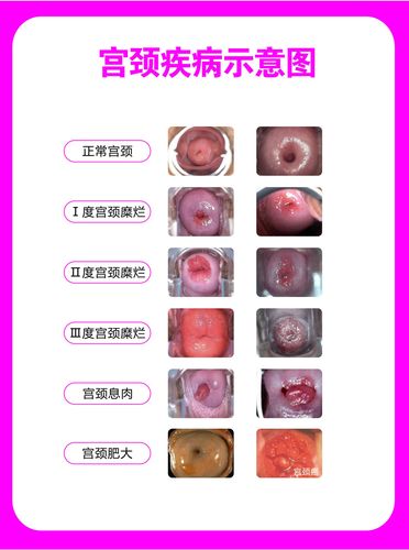 751海报印制展板写真喷绘470医院健康知识妇科挂图宫颈疾病示意图