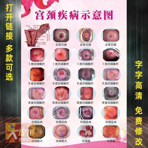 宫颈疾病示意图妇科门诊宣传海报病变级别挂图私密炎症子宫解剖图