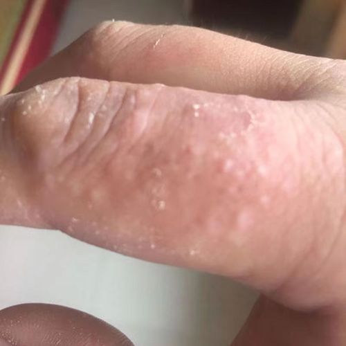 汗疱疹手上小水泡手痒脱皮干裂手脚开裂膏痒真菌感染止痒膏鹅掌风