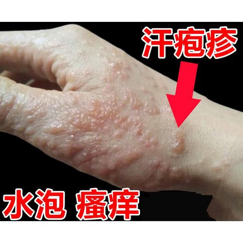 手上起小水泡手上长水泡手脚脱皮干裂皮肤过敏手瘙痒季节性过敏膏