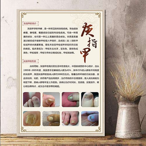 灰指甲海报足疗保健店养生馆挂图疗养修脚病理图解宣传图装饰画