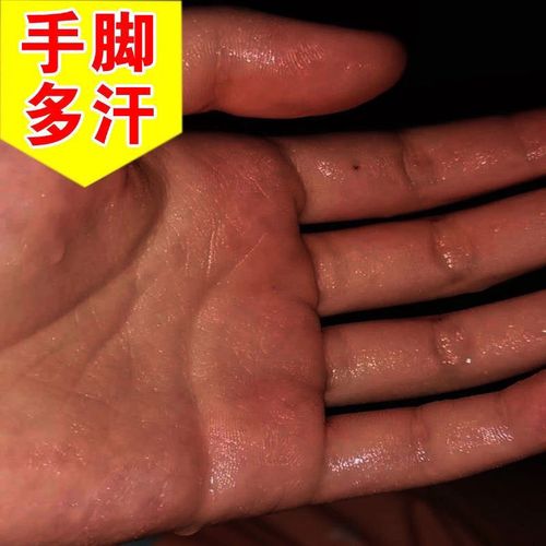 止手汗去手汗防手汗症中药手足多汗止汗神器手心脚心出汗调理标本