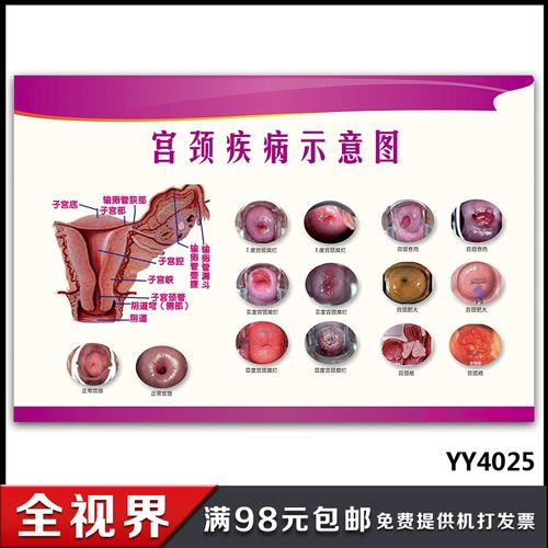 女性宫颈病症示意图展板 医院妇科健康知识宣传挂图 子宫保养海报