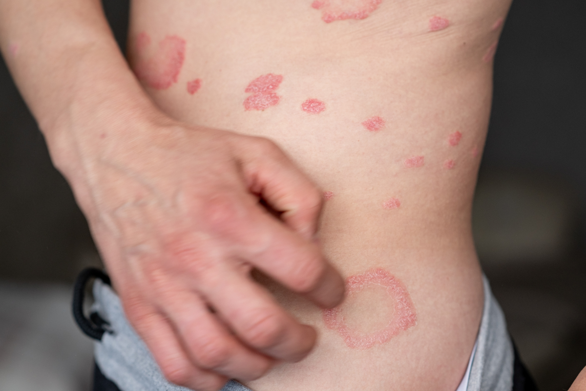 银屑病的4大谣言 你还在信吗 牛皮癣网传的4大谣言,你被骗了吗?