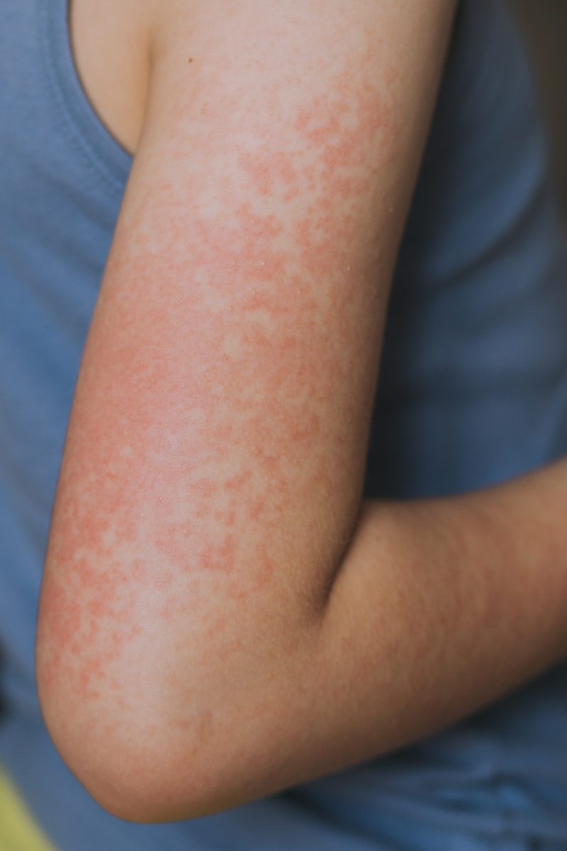 一个不起眼的"红疹,疼起来竟让人痛不欲生!