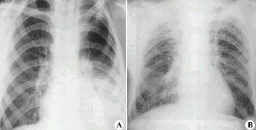 间质性肺炎最好的治疗方式是什么