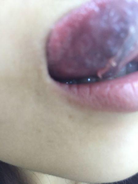 刚没事做,看舌头下面发现了这个,两边都有,拉起来像肉芽,透明状,不疼