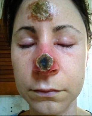 女子偏方治疗皮肤癌致溃烂 鼻子被腐蚀掉一半