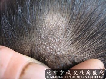 头癣会有哪些危害呢