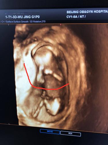 孕13周,nt顺利通过,可以看到宝宝的小人型啦,在揉眼睛好像!